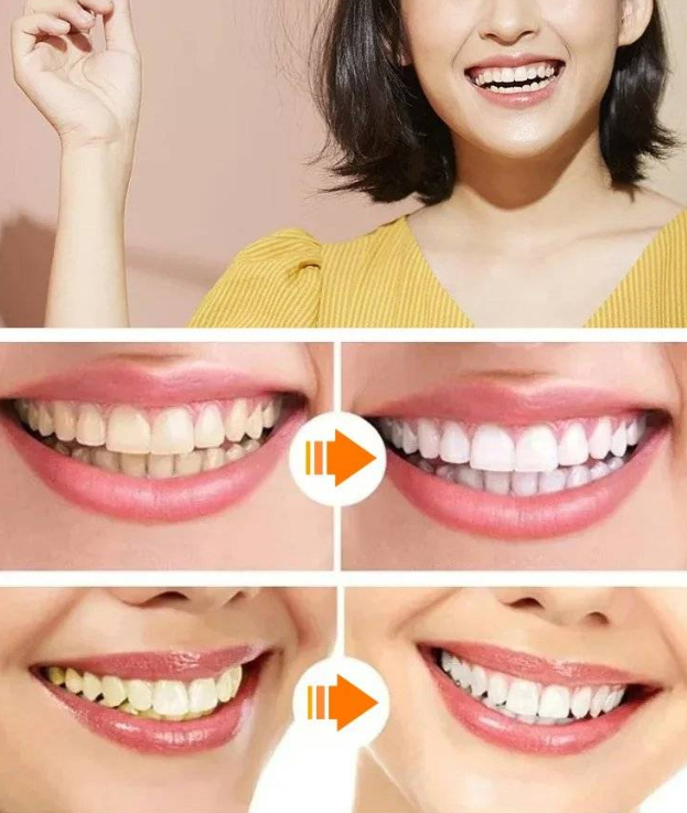 進口美白仿真牙套